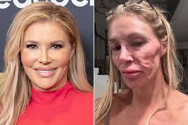 Brandi Glanville Spent $70K Trying to Find Cure for Face 'Parasite'