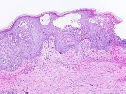 This condition can also occur as a primary infection in individuals taking immunosuppressive drugs and it is therefore considered as an opportunistic disease [ 1 Pathology Outlines Herpes Simplex Zoster