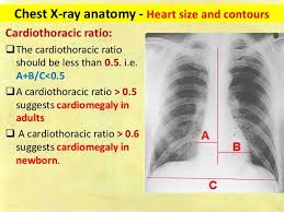 Chest X Ray Fundamentals Radiology Imaging X Ray Anatomy