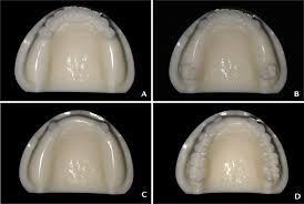 This type of prosthesis is referred to as a removable partial. Adaptation Of Removable Partial Denture Frameworks Fabricated By Selective Laser Melting Journal Of Prosthetic Dentistry