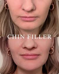 NEW TO DAXXIFY 💉✨ This patient has been receiving Dysport treatments  regularly over the last year but has found a need for touch ups and wanted  to try something new. We discussed