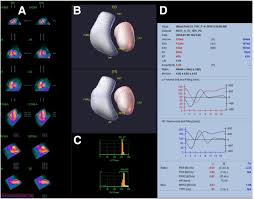 Image result for Nuclear Ventriculogram
