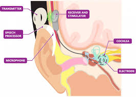 Image result for Cochlear Implant