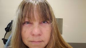 Milkweed sap residue can cause eye irritation