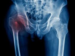 Des éléments de prothèse monoblocs choisis parmi une cupule acétabulaire destinée à une prothèse de la hanche, ainsi qu'un composant tibial et un composant fémoral destinés à une prothèse du genou, qui comprennent un corps. Chirurgie De La Fracture De La Hanche Indications Et Traitements Top Sante