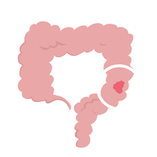 Warning signs of cancer in children cancer in children is rare and potentially curable in over 70% of patients. Colon Cancer Overview And More