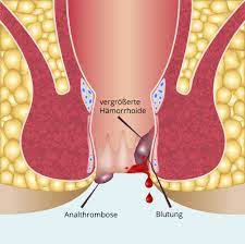 0,5 cm durchmesser an der innenseite meiner unterlippe entdeckt. Analthrombose Ausloser Symptome Behandlung
