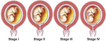 Image result for Chorioamnionitis