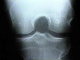 Image result for Knee XRay