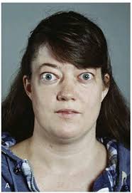 I am switching over from Synthroid to NP thyroid. I was diagnosed with  Graves' disease about 15 years ago and Hashimoto's. Between synthriod and  np thyroid I was using a natural bovine