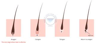 Laser hair removal devices work by killing the hair follicle. Laser Hair Removal For Men