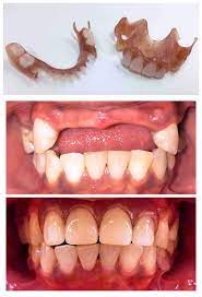 Partial dentures, also called partials, are artificial replacement teeth that restore a few missing teeth in a patient's mouth. Removable Flex Partial Denture The Dental Emergency Room