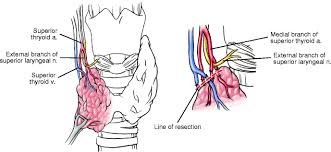 Ever heard of the glottal t? Neck Springerlink