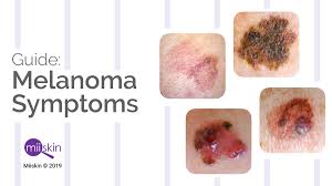 There are about 87,000 cases of melanoma each year. Melanoma Symptoms And Signs Extensive Guide