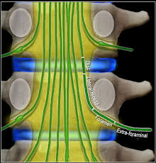 And sympathetic plexus $u!ular foramen inferior petrosal sinus lossopharyngeal, vagus and. The Radiology Assistant Lumbar Disc Herniation