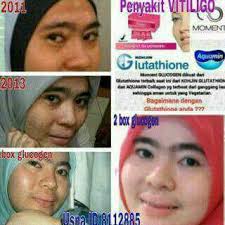 Untuk itu anda perlu mengetahui beberapa jenis makanan yang cukup baik dikonsumsi oleh mereka yang ginjalnya memiliki masalah. Vitiligo Merupakan Penyakit Yang Moment Infinity Bali Facebook