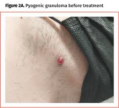 Image result for Pyogenic Granuloma