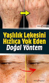 Yaslilik Lekelerini Yok Etmenin 4 Dogal Yolu 2020 Dogal Cilt Bakimi Yuzler