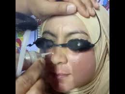 Produk berkesan buang tahi lalat hidup dan tahi lalat biasa. Laser Buang Tahi Lalat Youtube