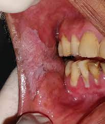 They are found in the tissue that forms the surface of the skin, the lining of the hollow organs. Tobacco Related Oral Cancer The Bmj