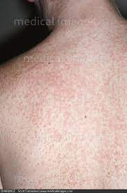 Stock Image Close Up Of A Skin Rash Due To An Allergic Reaction To The Antibiotic Clindamycin On The Back Of A 16 Year Old Male 111428 01aeqvdz Scottcamazine Search Medical