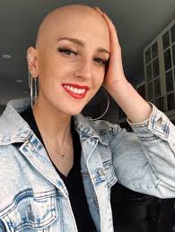 GALERIE: Doma se nestydím, ale ven nosím paruku, říká krásná dívka s  alopecií