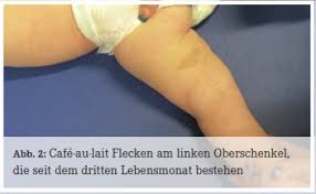 It differs from white coffee, which is coffee with cold milk or other whiteners added. Infothek Genetikum Neurofibromatose Typ I Eine Kasuistik