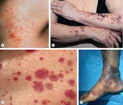 Other skin lesions associated with hsp include large hives (urticarial wheals) or ulcers (necrotic), especially on the buttocks and legs. Purpura Mechanisms And Differential Diagnosis Plastic Surgery Key