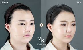 Jk Plastic Surgery In South Korea Korean Plastic Surgery Best Plastic Surgery In Korea Korean Plastic Surgery Plastic Surgery Korea South Korea Plastic Surgery