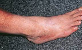 Leg and foot rashes are also a complication of poorly managed diabetes and peripheral artery disease, which can cause skin changes due to poor blood flow to the extremities. Skin Signs Of Vascular Disorders Cardiology