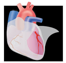 A pericardite pode ser aguda ou crônica, a depender dos sintomas apresentados pelo paciente. Pericarditis Archives Medical Actu