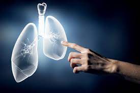 Stage 4 lung cancer means the cancer has spread. What Are The Symptoms Of Stage 4 Lung Cancer Lung Cancer Lawsuit Lawyers Pintas Mullins Law Firm