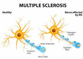 Jun 12, 2020 · there is no cure for multiple sclerosis. Multiple Sclerosis Ms Anova Irm Germany