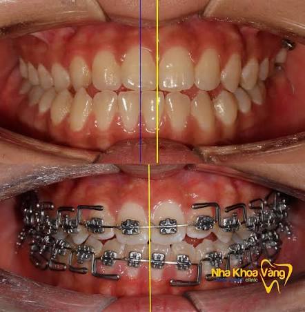 Something changes - MLD patient. Một vài thay đổi nhỏ với bệnh nhân lệch  mặt. ---- ➡Bệnh nhân nữ 19 tuổi, đến với mặt lệch và khớp cắn ngược. 5  tháng điều