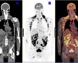 Le scanner, aussi appelé tomodensitométrie, est un examen qui donne des images en coupe d'un organe. Explorations Thorax Scanner Fibroscopie Endoscopie Hop Bichat Chirvtt