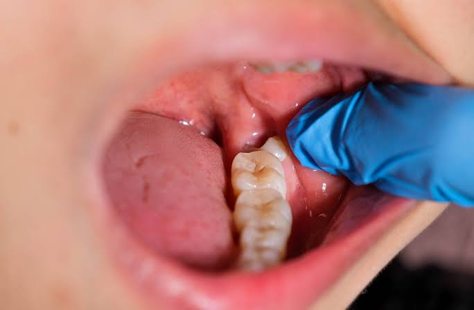 Do I Need My Wisdom Teeth Removed? 10 Signs to Watch For