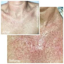 This is usually when it happens to be in a spot where it is frequently irritated and ends up bleeding. Cherry Angiomas Sharon Gordon Skin