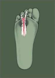 Metatarsalgia Morton S Neuroma Birkenstock Usa Official Site Neuroma Morton S Neuroma Feet Care