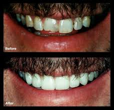 If a single root is left behind, if will result in infection , sepsis and a lot of bad things unfortunately, you can't fix a rotten tooth by yourself without the help of tools and numbing medication. Cosmetic Dental Bonding Signature Smiles Thomasville