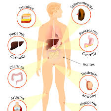 Image result for acholic stools human