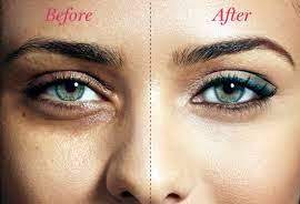Dark Circles Treatment In Hisar Dark Circles Treatment Clinic In Hisar Dark Circles Treatment Hospital In Hisar Best Clinic For Dark Circles Treatment In Hisar