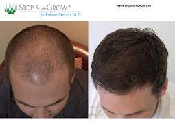 The regrowth methods most often recommended to hair loss sufferers are minoxidil and topical minoxidil appears to be effective in helping to maintain nonvellus hair growth in men with androgenetic alopecia. Men Stop Hair Loss Regrow Hair Now Jay Bradley
