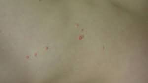If the bumps are scratched or injured, the infection can spread to surrounding skin. Molluscum Contagiosum Causes Symptoms Treatment And Pictures