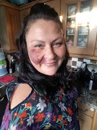 IDNC that i have a port wine stain