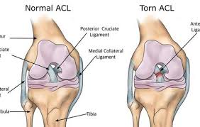 Learn about the causes and symptoms of an acl injury here, as well as about the treatment options and. Knee Injury Archives Back In Action