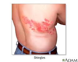 Symptoms typically start with pain along the affected. Herpes Zoster Physiopedia