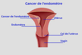 Quelles sont les chances de survie ? Donnees Epidemiologiques Sur Le Cancer Du Col De L Uterus