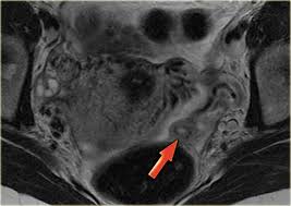 Image result for corpus luteum sonography)