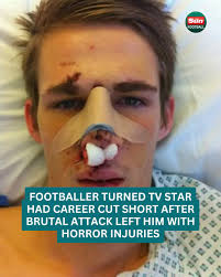 He was left in a face mask for six months after the brutal attack 🥺