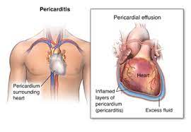 The pericardium comprises two layers; Pericarditis